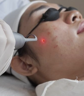 Bắn Nốt Ruồi, Mụn Thịt, Mụn Cóc