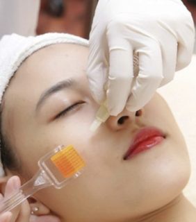Lăn Kim Se Khít Lỗ Chân Lông