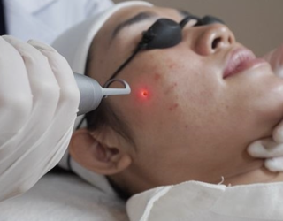 Bắn Nốt Ruồi, Mụn Thịt, Mụn Cóc