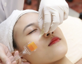 Lăn Kim Se Khít Lỗ Chân Lông