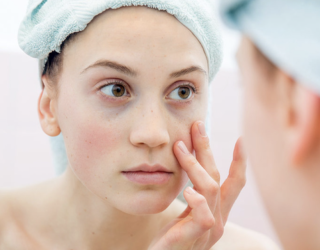 Điều Trị Thâm Quầng Mắt